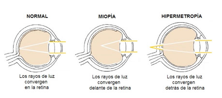 Miopia