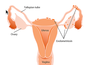 tramamiento-y-casuas-endometriosis